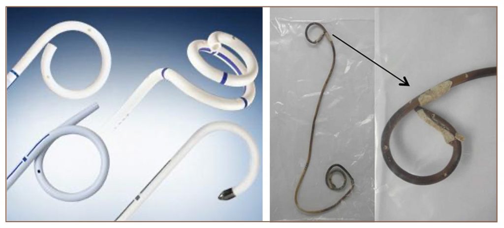 Flexible-sistoskop-yardimiyla-stent-nasil-cikarilir-Tassiz-Hayat-Dr-Kadir-Tepeler-Urolife